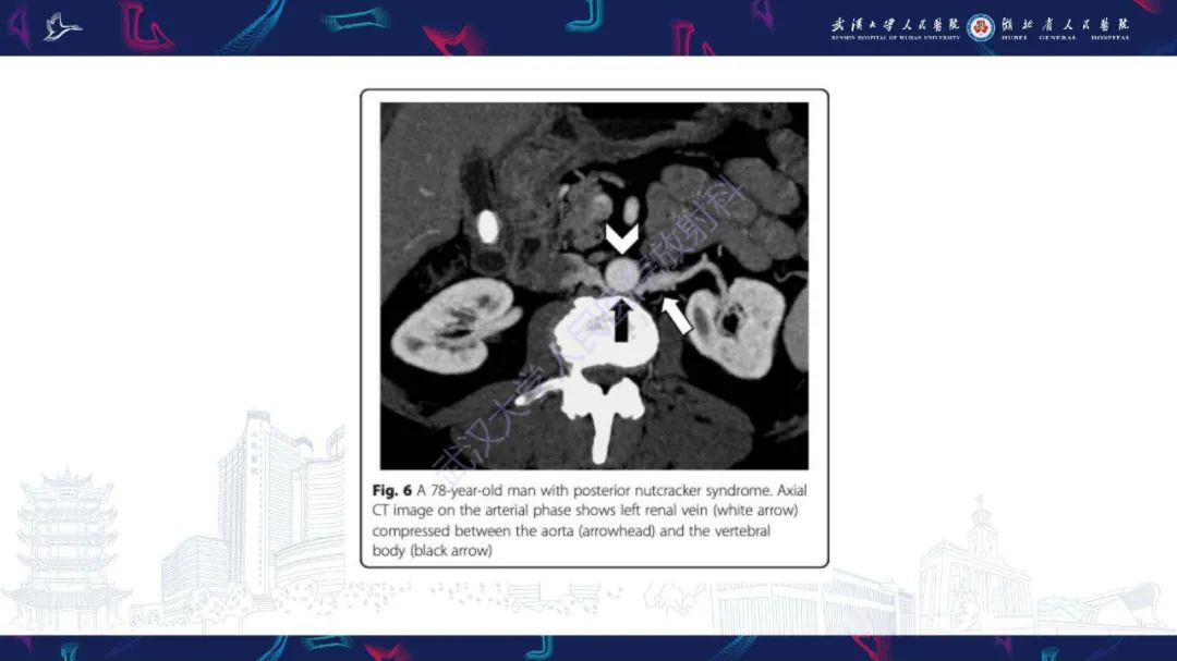 影像PPT - 【PPT】腹盆腔血管压迫综合征CT诊断-12