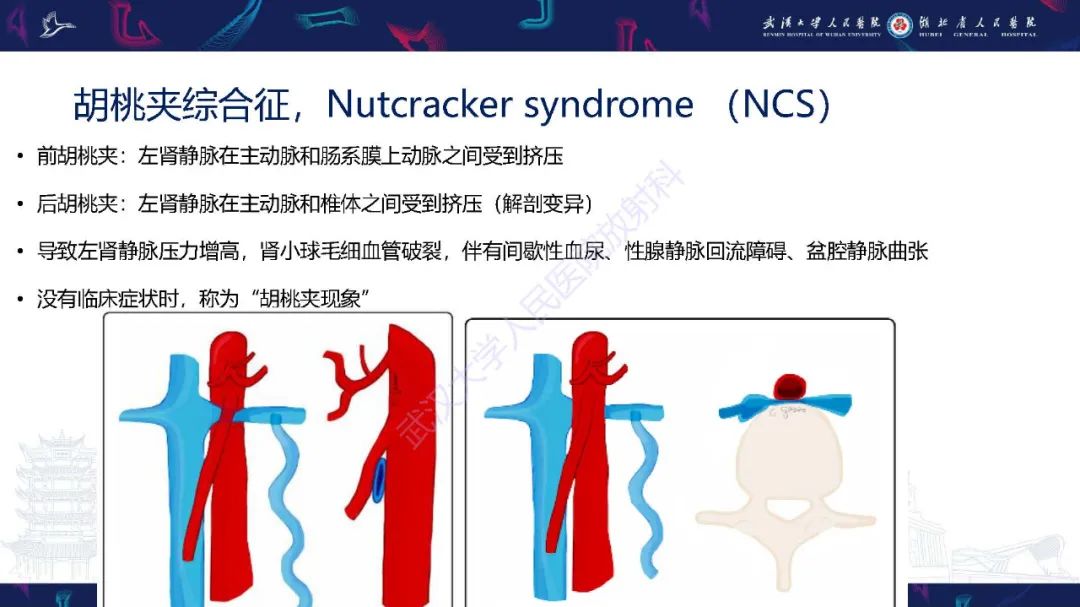 影像PPT - 【PPT】腹盆腔血管压迫综合征CT诊断-10