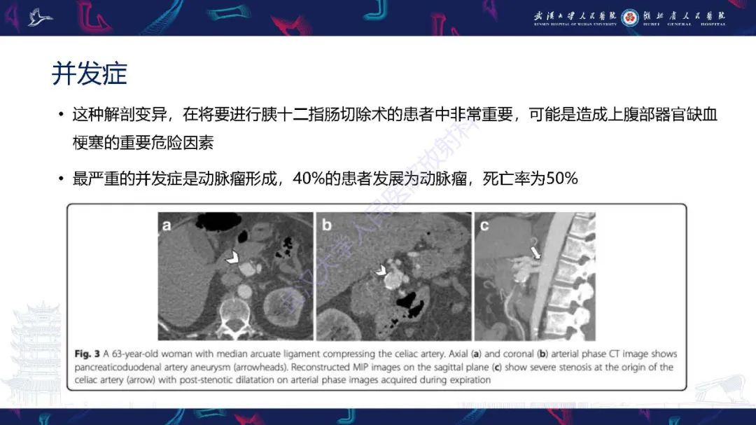 影像PPT - 【PPT】腹盆腔血管压迫综合征CT诊断-8