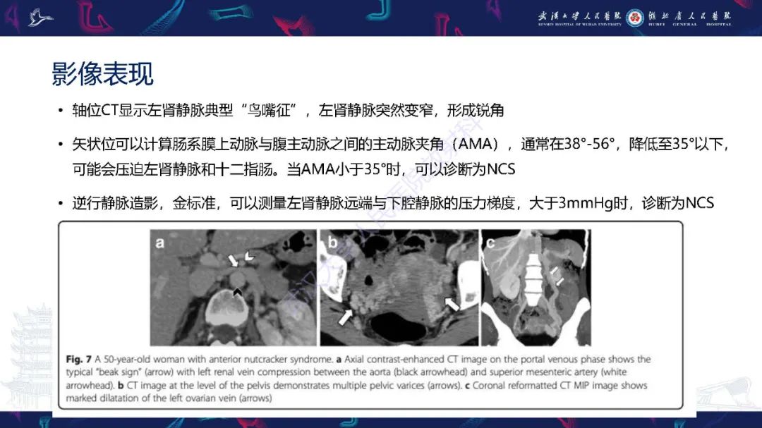 影像PPT - 【PPT】腹盆腔血管压迫综合征CT诊断-11
