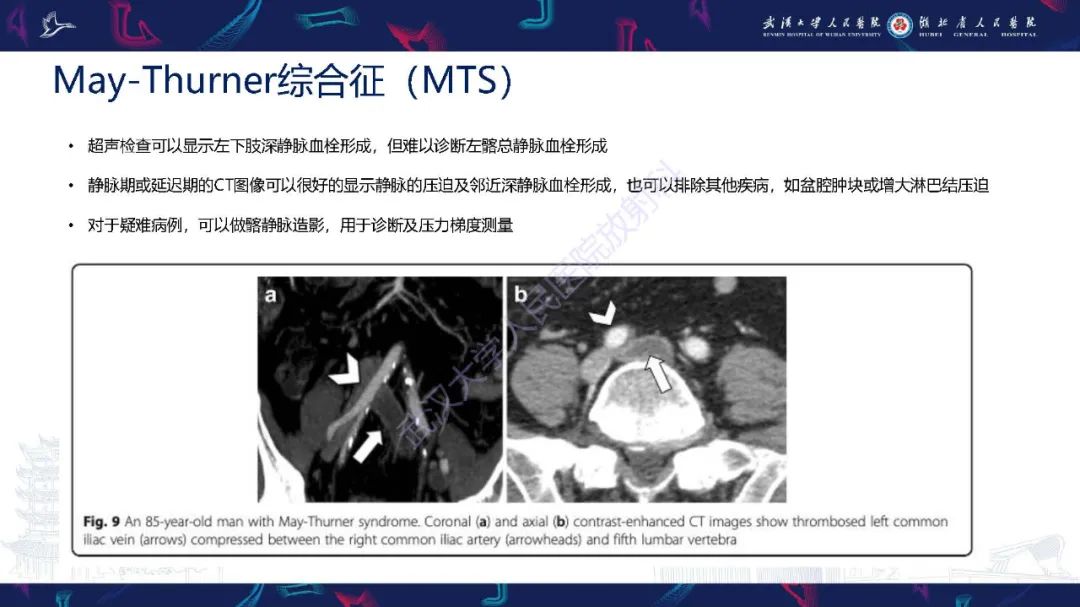 影像PPT - 【PPT】腹盆腔血管压迫综合征CT诊断-15