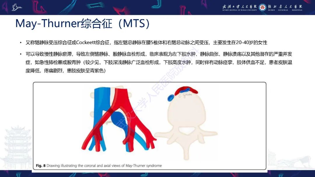 影像PPT - 【PPT】腹盆腔血管压迫综合征CT诊断-14