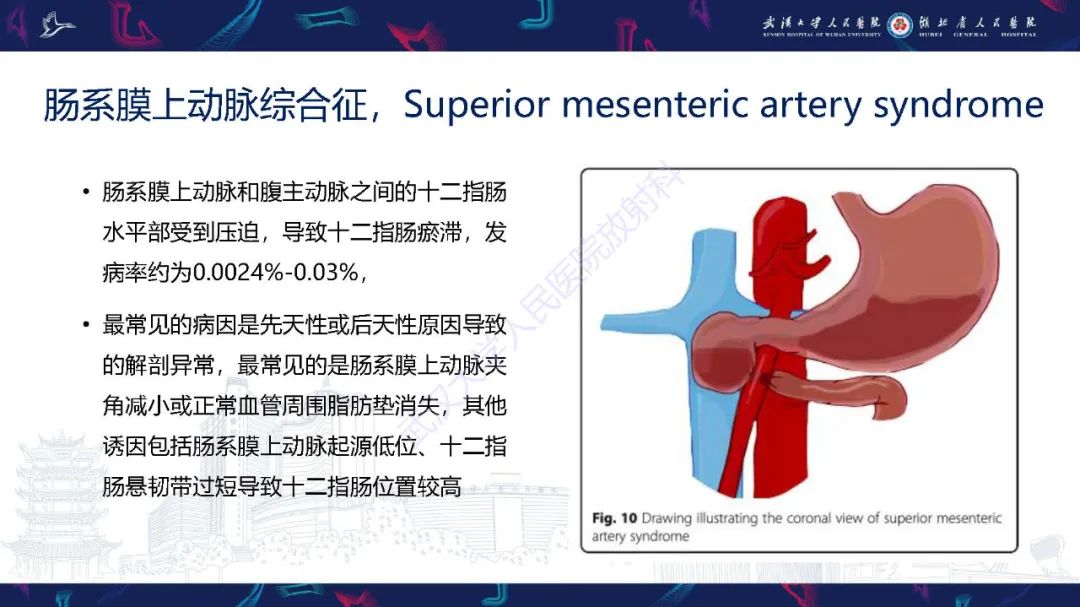 影像PPT - 【PPT】腹盆腔血管压迫综合征CT诊断-17
