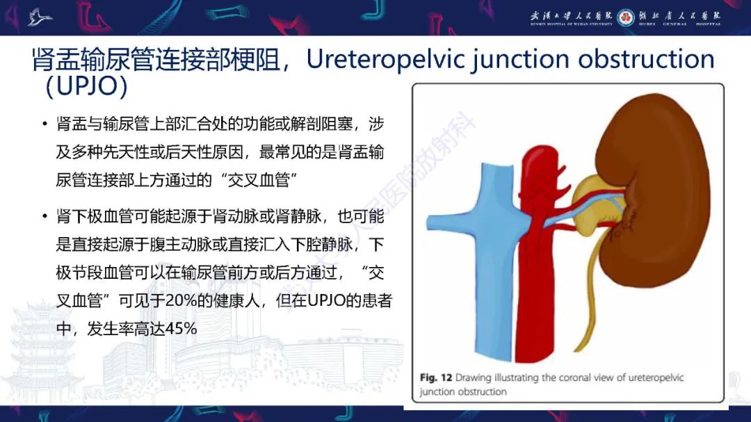影像PPT - 【PPT】腹盆腔血管压迫综合征CT诊断-21
