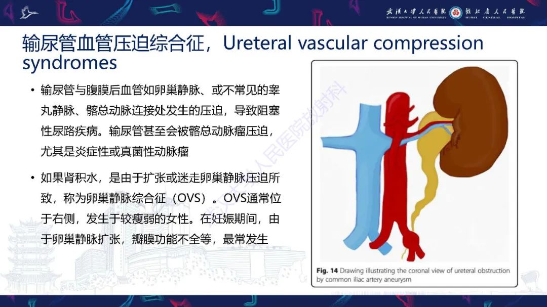 影像PPT - 【PPT】腹盆腔血管压迫综合征CT诊断-25