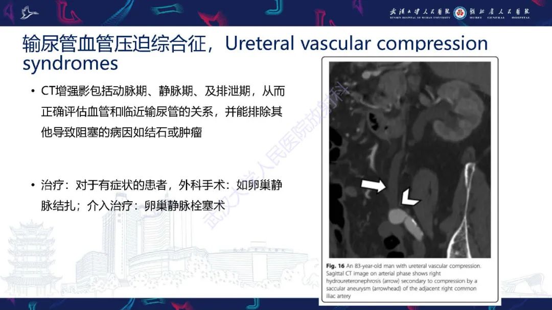 影像PPT - 【PPT】腹盆腔血管压迫综合征CT诊断-27