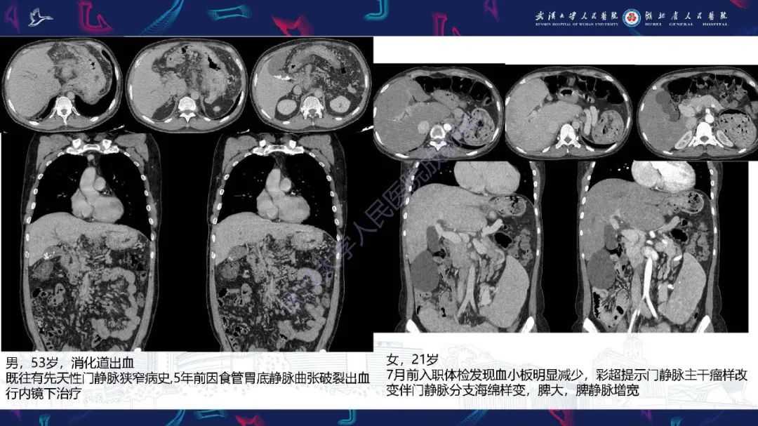 影像PPT - 【PPT】腹盆腔血管压迫综合征CT诊断-31