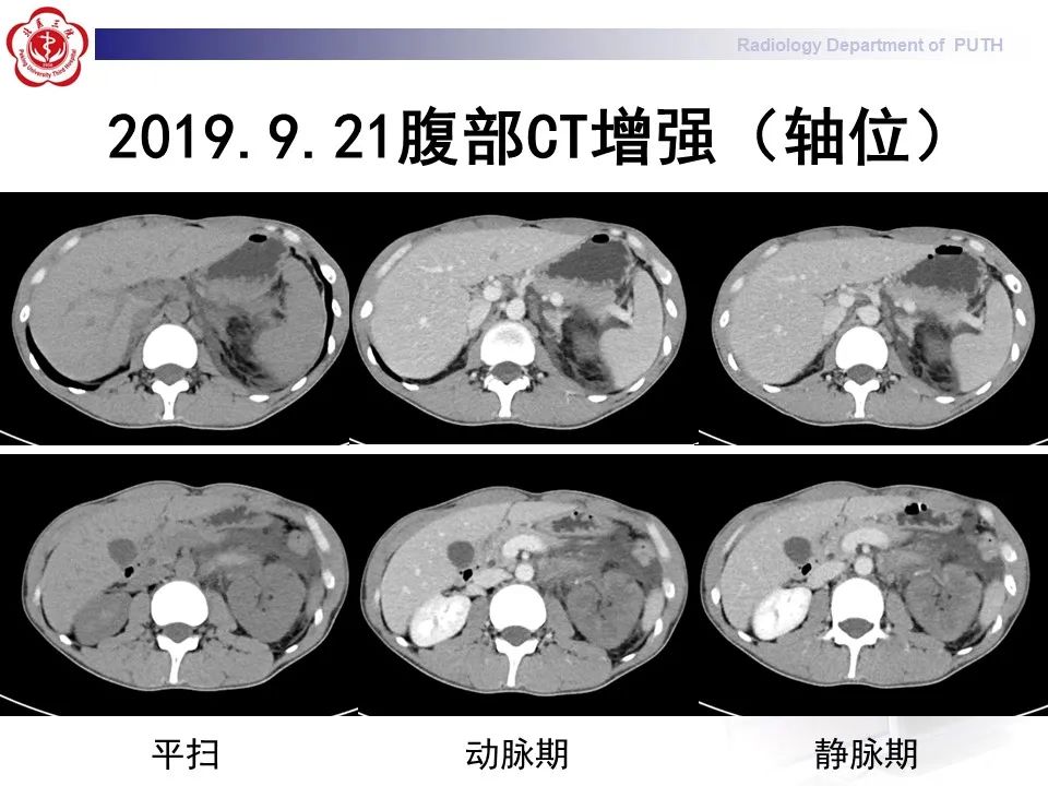 影像PPT - 【PPT】抗磷脂综合征合并双侧肾上腺坏死-4