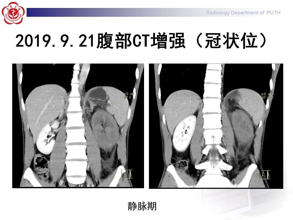 影像PPT - 【PPT】抗磷脂综合征合并双侧肾上腺坏死-5