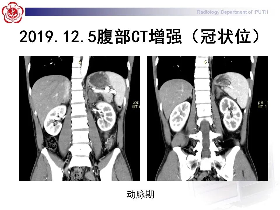影像PPT - 【PPT】抗磷脂综合征合并双侧肾上腺坏死-9