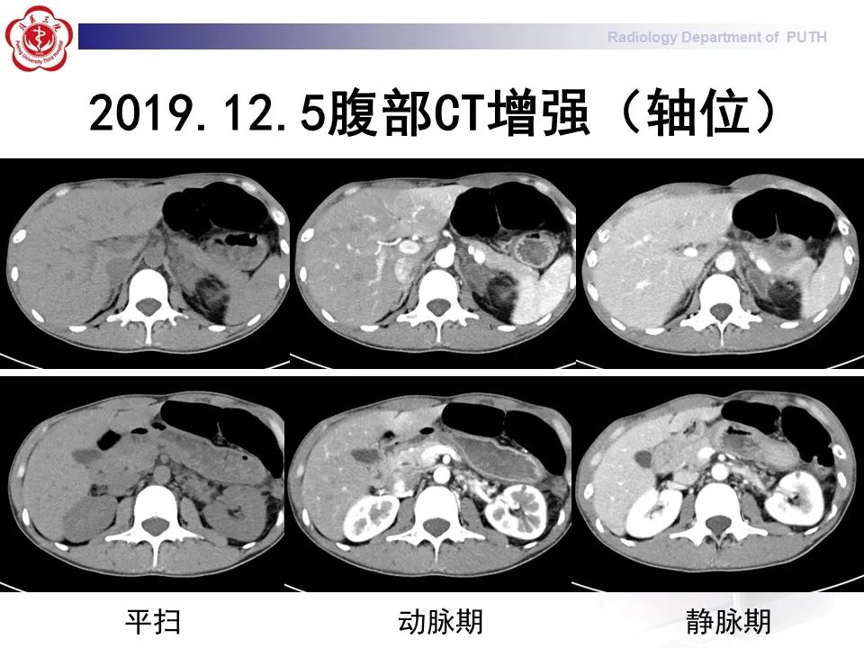 影像PPT - 【PPT】抗磷脂综合征合并双侧肾上腺坏死-8