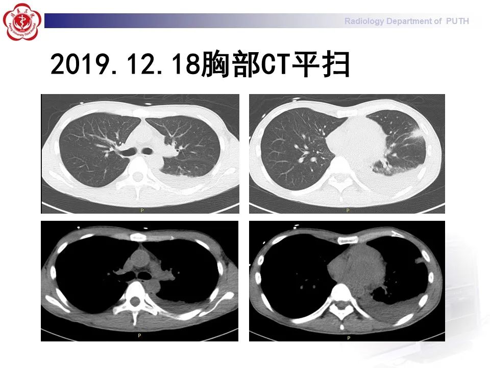 影像PPT - 【PPT】抗磷脂综合征合并双侧肾上腺坏死-11