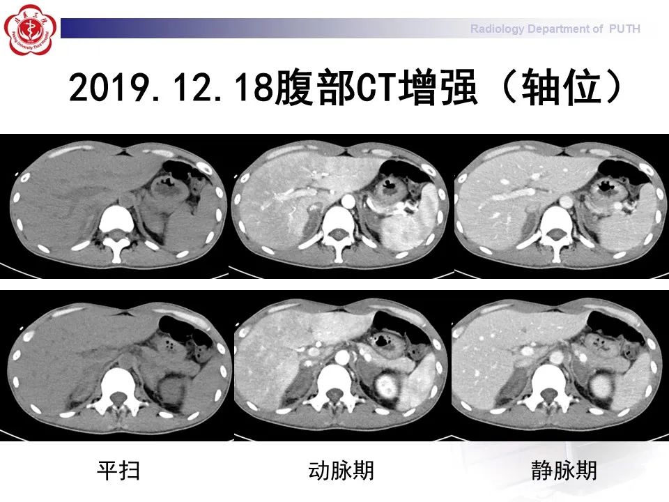 影像PPT - 【PPT】抗磷脂综合征合并双侧肾上腺坏死-12