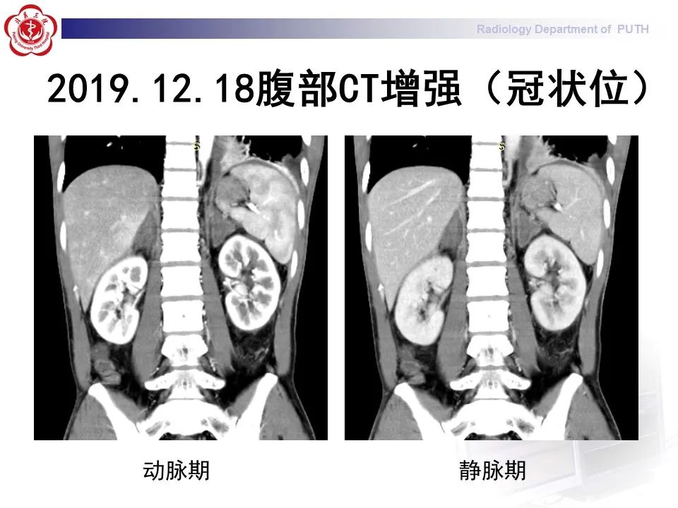 影像PPT - 【PPT】抗磷脂综合征合并双侧肾上腺坏死-13
