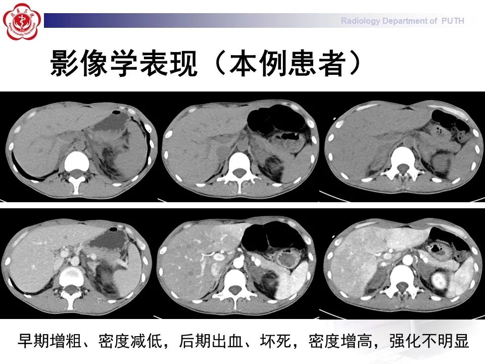 影像PPT - 【PPT】抗磷脂综合征合并双侧肾上腺坏死-27