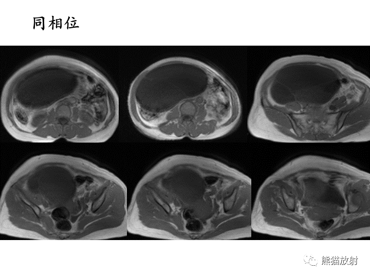 影像PPT - 【病例】卵巢黏液性囊腺瘤 VS 卵巢黄素囊肿-7