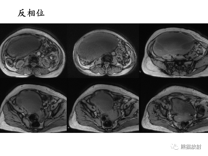 影像PPT - 【病例】卵巢黏液性囊腺瘤 VS 卵巢黄素囊肿-8