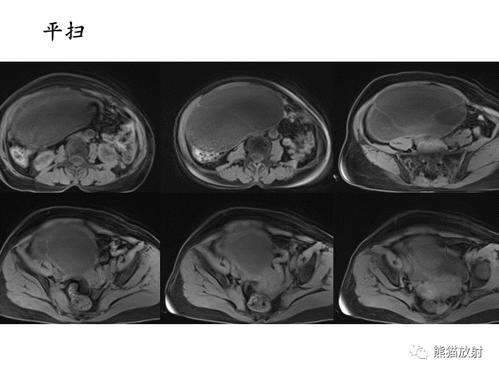 影像PPT - 【病例】卵巢黏液性囊腺瘤 VS 卵巢黄素囊肿-9