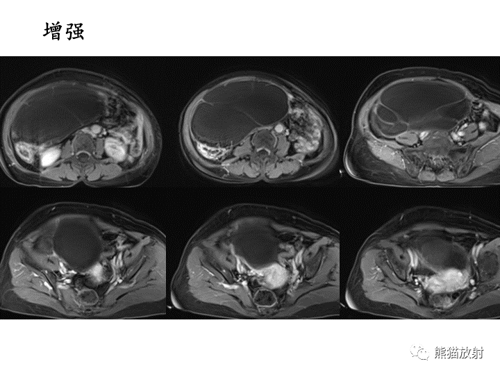 影像PPT - 【病例】卵巢黏液性囊腺瘤 VS 卵巢黄素囊肿-10
