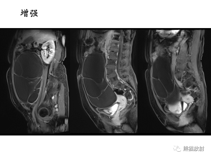 影像PPT - 【病例】卵巢黏液性囊腺瘤 VS 卵巢黄素囊肿-12