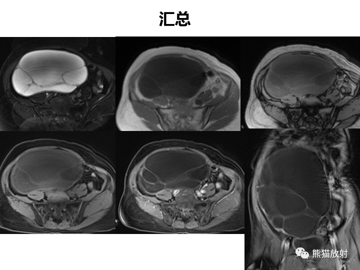 影像PPT - 【病例】卵巢黏液性囊腺瘤 VS 卵巢黄素囊肿-13