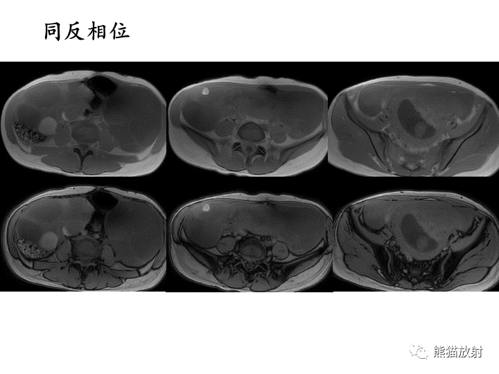影像PPT - 【病例】卵巢黏液性囊腺瘤 VS 卵巢黄素囊肿-20
