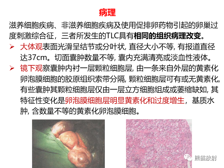 影像PPT - 【病例】卵巢黏液性囊腺瘤 VS 卵巢黄素囊肿-30