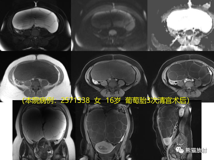 影像PPT - 【病例】卵巢黏液性囊腺瘤 VS 卵巢黄素囊肿-32