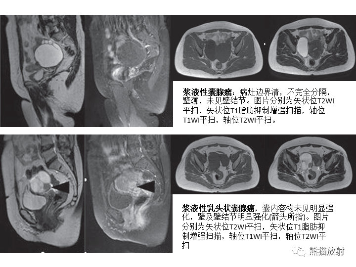 影像PPT - 【病例】卵巢黏液性囊腺瘤 VS 卵巢黄素囊肿-36