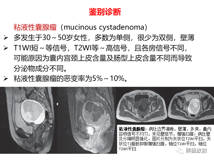 影像PPT - 【病例】卵巢黏液性囊腺瘤 VS 卵巢黄素囊肿-37