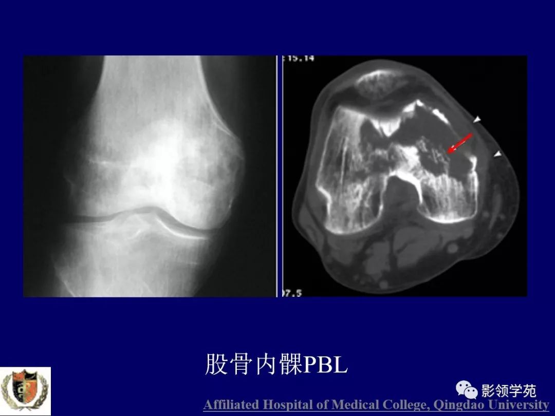 影像PPT - 【PPT】原发性骨淋巴瘤影像学诊断-8