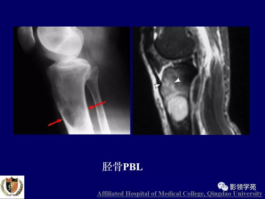影像PPT - 【PPT】原发性骨淋巴瘤影像学诊断-9