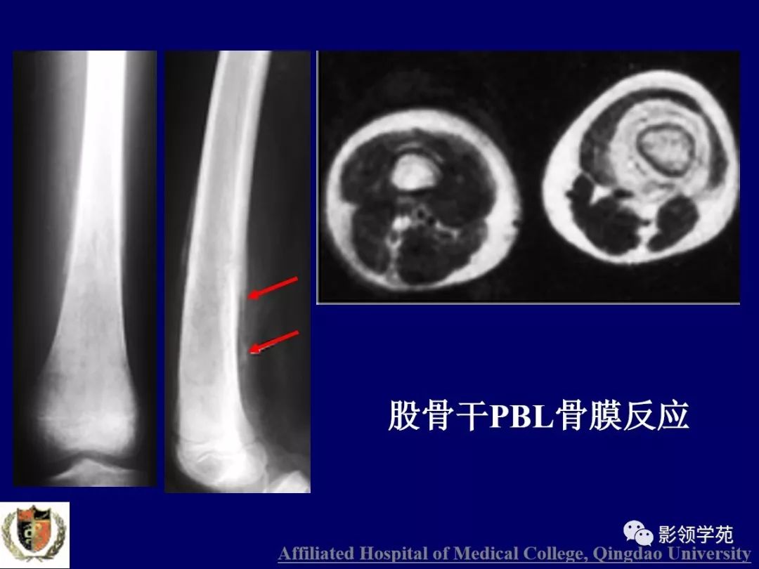 影像PPT - 【PPT】原发性骨淋巴瘤影像学诊断-10