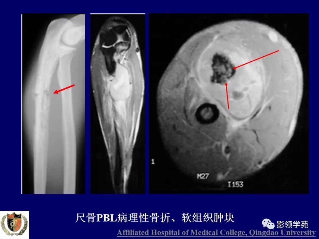 影像PPT - 【PPT】原发性骨淋巴瘤影像学诊断-11
