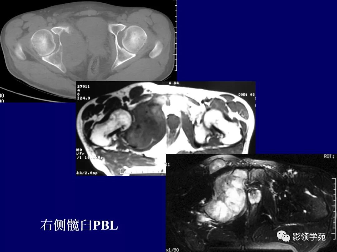 影像PPT - 【PPT】原发性骨淋巴瘤影像学诊断-12