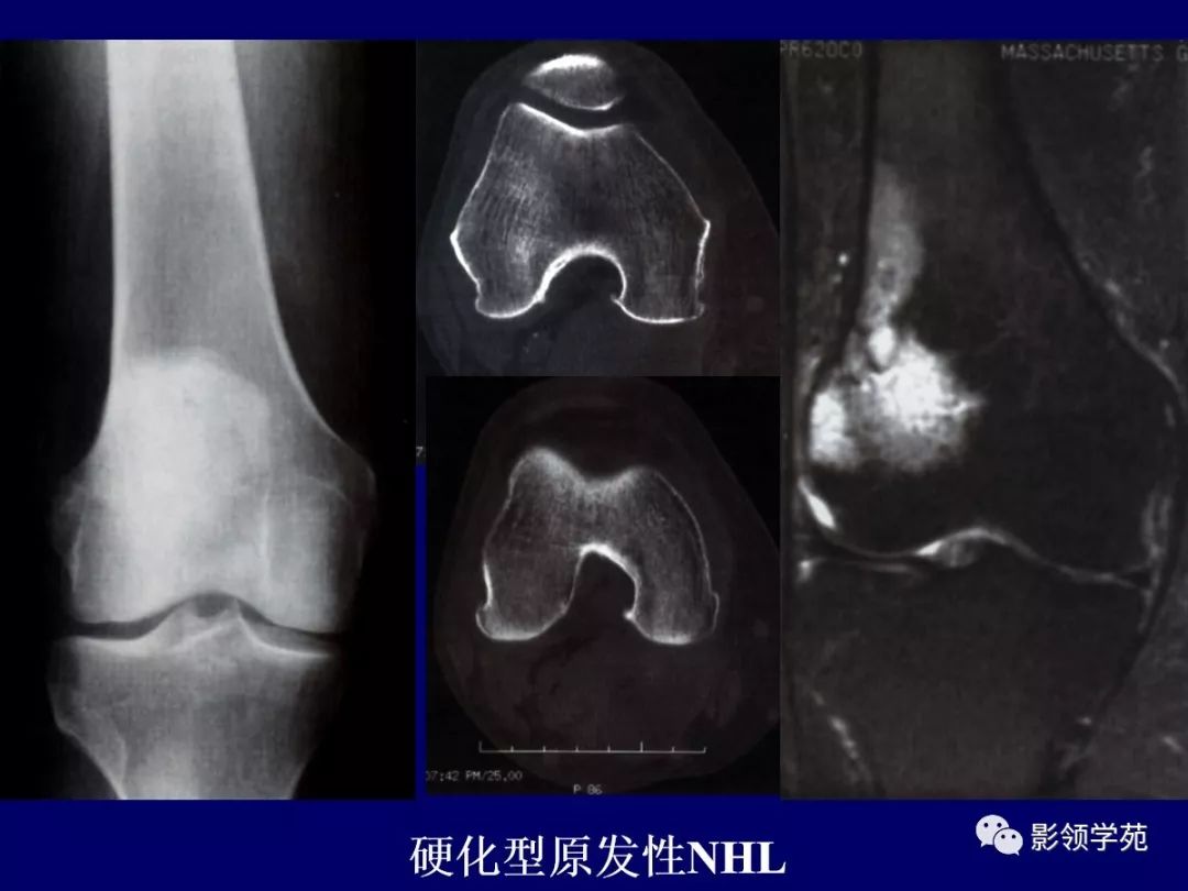 影像PPT - 【PPT】原发性骨淋巴瘤影像学诊断-14