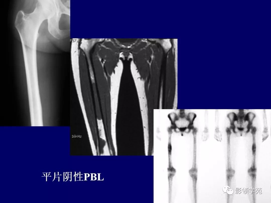 影像PPT - 【PPT】原发性骨淋巴瘤影像学诊断-16