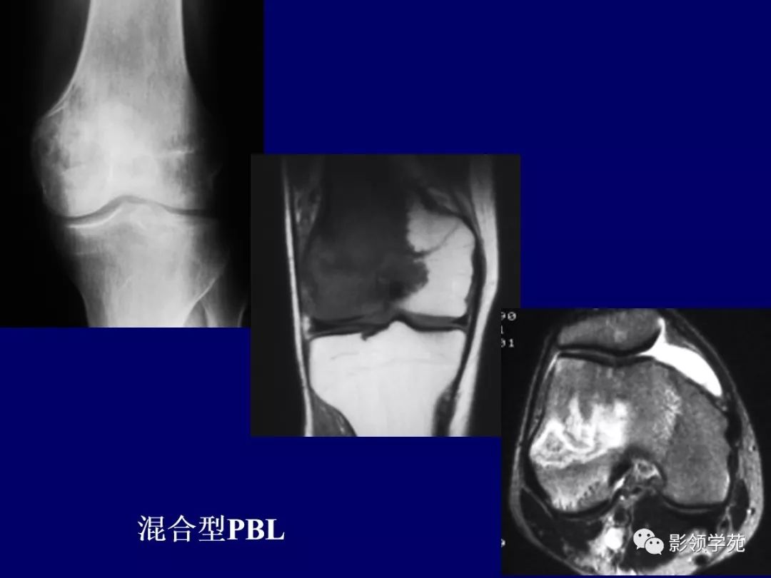影像PPT - 【PPT】原发性骨淋巴瘤影像学诊断-15