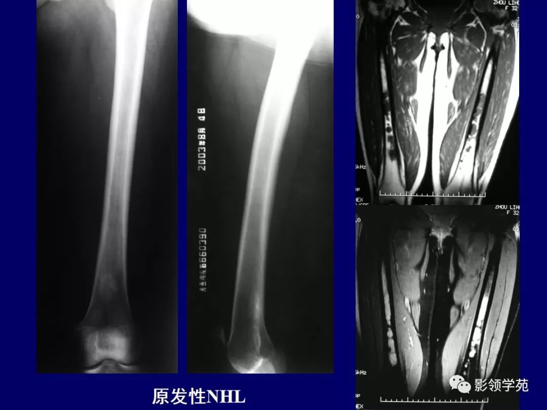 影像PPT - 【PPT】原发性骨淋巴瘤影像学诊断-17