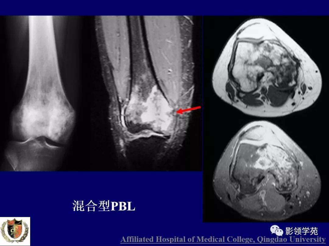 影像PPT - 【PPT】原发性骨淋巴瘤影像学诊断-22