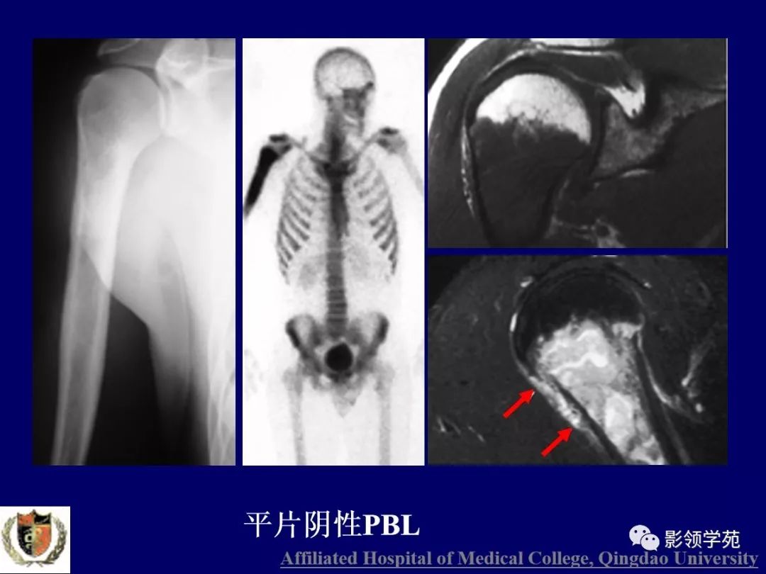 影像PPT - 【PPT】原发性骨淋巴瘤影像学诊断-23