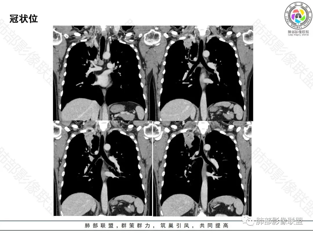 影像PPT - 【病例】局灶性机化性肺炎1例CT影像-14 影像PPT - 【病例】局灶性机化性肺炎1例CT影像-14