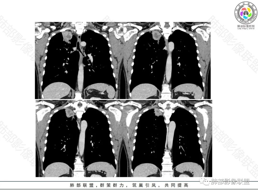 影像PPT - 【病例】局灶性机化性肺炎1例CT影像-15 影像PPT - 【病例】局灶性机化性肺炎1例CT影像-15