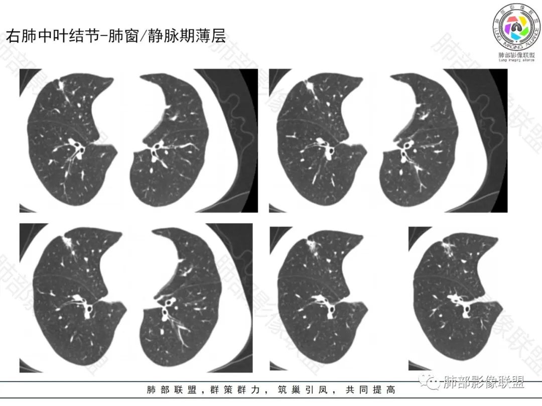 影像PPT - 【病例】局灶性机化性肺炎1例CT影像-18 影像PPT - 【病例】局灶性机化性肺炎1例CT影像-18