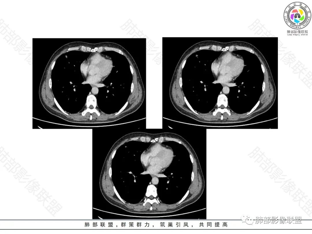 影像PPT - 【病例】局灶性机化性肺炎1例CT影像-19 影像PPT - 【病例】局灶性机化性肺炎1例CT影像-19