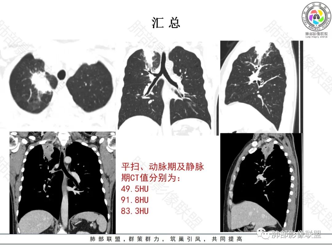 影像PPT - 【病例】局灶性机化性肺炎1例CT影像-20 影像PPT - 【病例】局灶性机化性肺炎1例CT影像-20