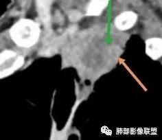 影像PPT - 【病例】局灶性机化性肺炎1例CT影像-26 影像PPT - 【病例】局灶性机化性肺炎1例CT影像-26