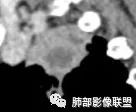 影像PPT - 【病例】局灶性机化性肺炎1例CT影像-27 影像PPT - 【病例】局灶性机化性肺炎1例CT影像-27