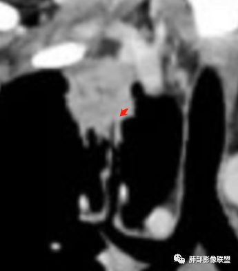 影像PPT - 【病例】局灶性机化性肺炎1例CT影像-31 影像PPT - 【病例】局灶性机化性肺炎1例CT影像-31
