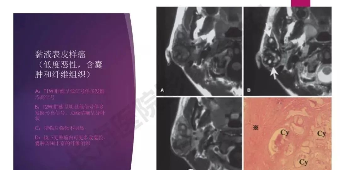 影像PPT - 【PPT】腮腺恶性肿瘤MR表现及鉴别-15